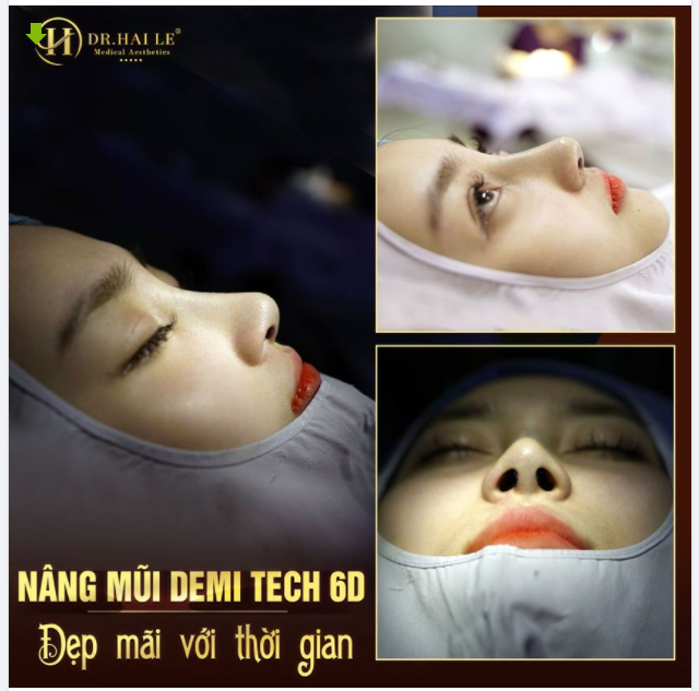 Nâng mũi Dr.Hải Lê chưa bao giờ hết HOT