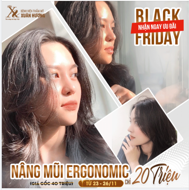 NÂNG MŨI ERGONOMIC CHỈ 20 TRIỆU (giá gốc 40 triệu)
