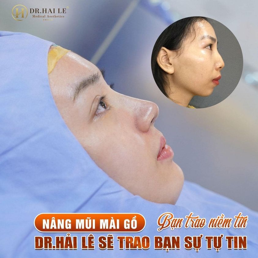 Nâng mũi - Mài gồ chuẩn phong thủy tại Dr.Hải Lê.!