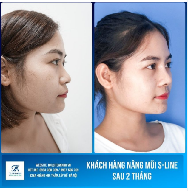 NÂNG MŨI SLINE ĐÃ GIÚP CÔ ẤY THAY ĐỔI RA SAO