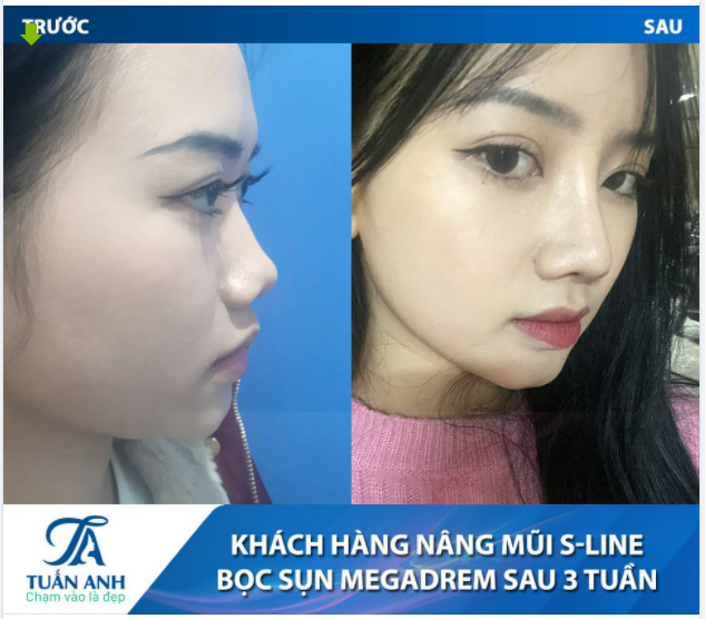 NÂNG MŨI SLINE KẾT HỢP BỌC SỤN MEGADERM - THAY ĐỔI THẦN THÁI