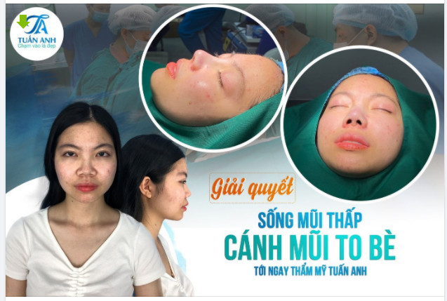 NÂNG MŨI SLINE KẾT HỢP THU GỌN CÁNH MŨI BỌC SỤN MEGADERM ĐẦU MŨI