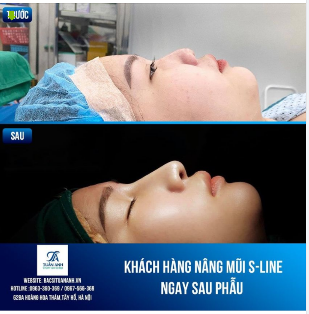 NÂNG MŨI SLINE - NÂNG THẦN THÁI ĐẸP HÀI HÒA