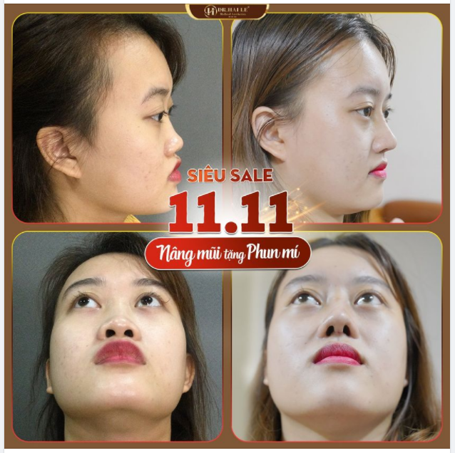 Nâng mũi tặng Phun mí mở tròng trị giá 1tr5