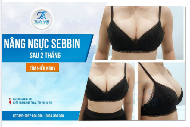 Nâng ngực SEBBIN siêu nhám kết quả ra sao 