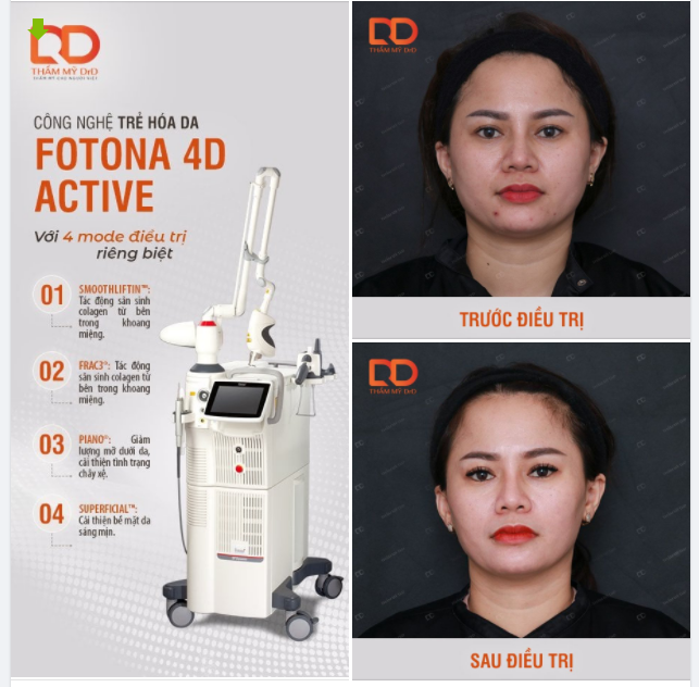 Nâng tầm chăm sóc, trẻ hóa da bằng Công nghệ trẻ hóa da Fotona 4D Active