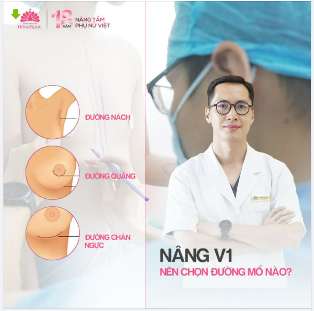 NÂNG V1 NÊN CHỌN ĐƯỜNG MỔ NÀO?