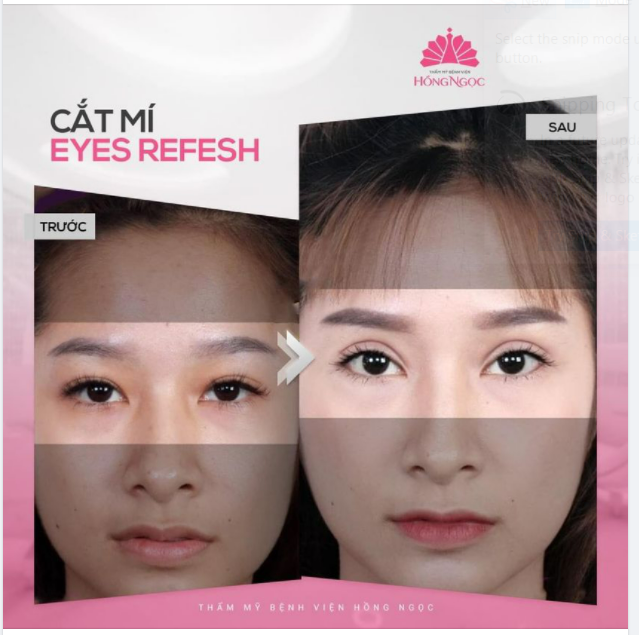 NẾP MÍ ĐẸP ''KHÔNG HỀ GIẢ TRÂN'' CỦA KHÁCH HÀNG NHÀ HỒNG NGỌC SAU 1 THÁNG THỰC HIỆN
