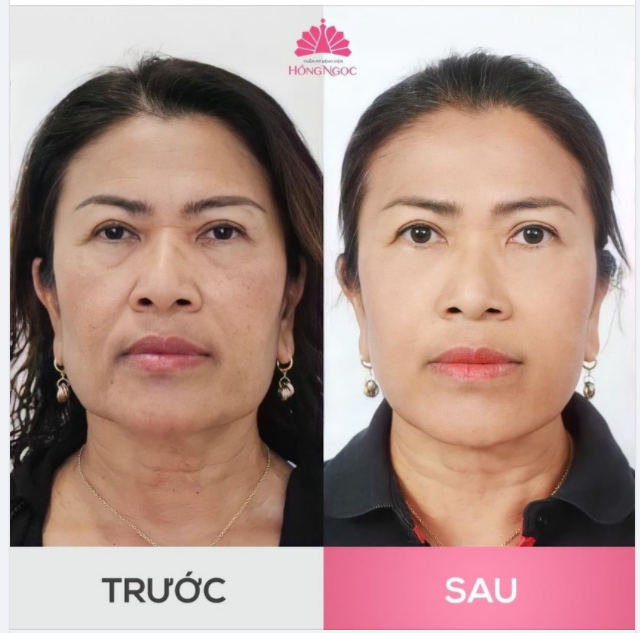 NẾP NHĂN HẰN SÂU - DA CHÙNG NHÃO - CƠ MẶT CHẢY XỆ