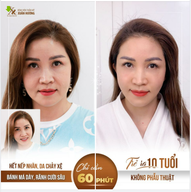 Nếu tuổi tác để lại trên da bạn nếp nhăn, rãnh mũi má Hãy để Xuân Hương giúp bạn lấy lại làn da trẻ hóa tuổi thanh xuân