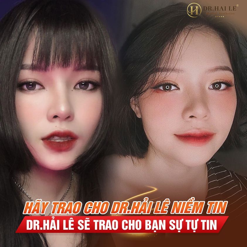 Nghe nói cắt mí đau lắm, kiêng khem dữ lắm, với cả cắt mí xong nhìn "giả" ah. KHÔNG HỀ NHA! mắt chỉ xấu, lỗi, giả khi thực hiện chưa đúng kỹ thuật mà thôi.