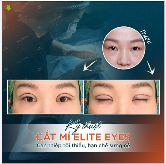 "Nhà" tôi có "bí quyết" Cắt mí không sưng, đến giờ vẫn còn thực hiện.