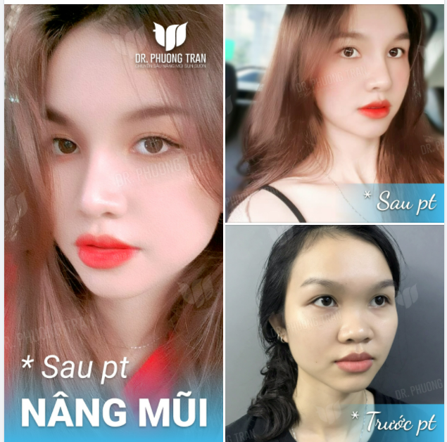 Nhan sắc bạn ấy quá xuất sắc sau nâng mũi cấu trúc phải không cả nhà? Quả là “dậy thì thành công”!