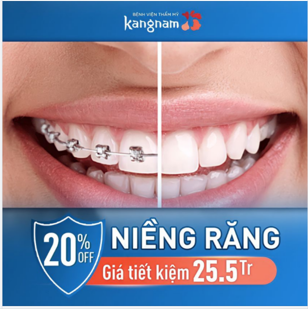 Niềng răng Kangnam trợ giá tới 20%