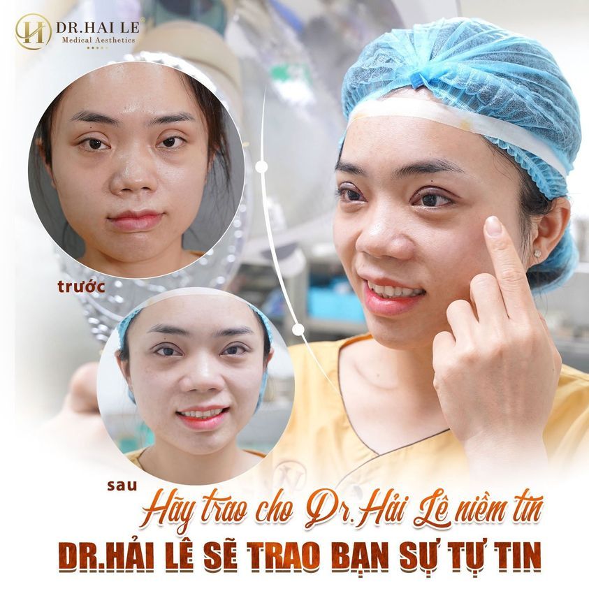 QUÁ BẤT NGỜ VỚI KẾT QUẢ SAU PHẪU THUẬT SỬA MÍ DEEP TECH!