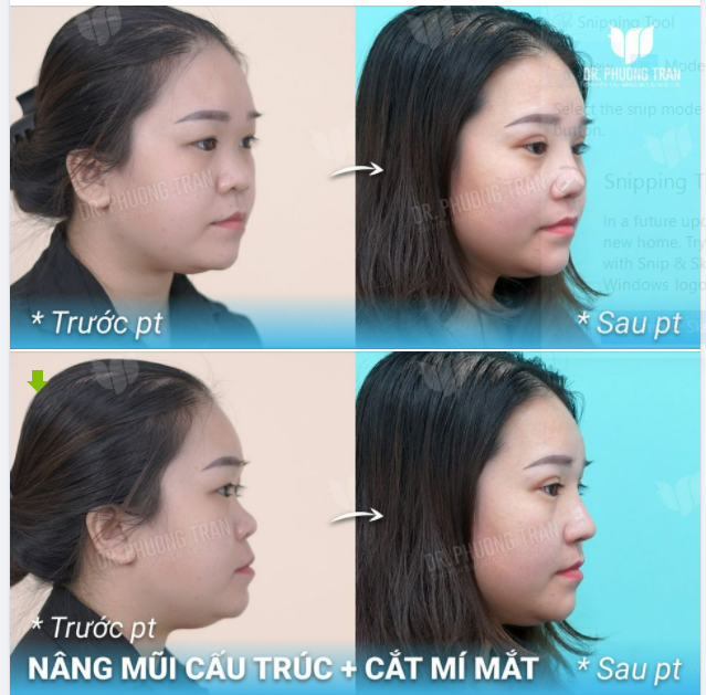 QUYẾT TÂM “LÀM MỚI”, BẠN ẤY CHỌN COMBO MẮT MŨI