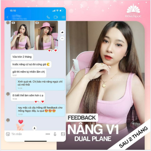 Quỳnh Chi đầy gợi cảm sau 2 tháng nâng V1 Dual Plane
