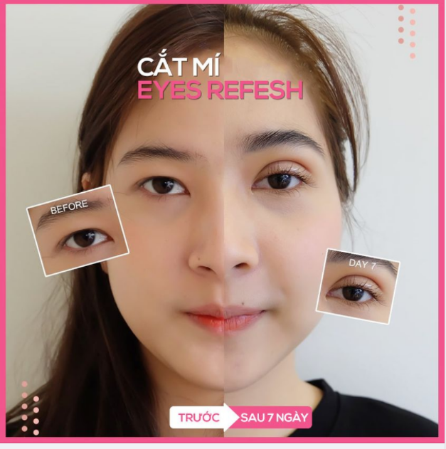 SẮC DIỆN GƯƠNG MẶT THAY ĐỔI HOÀN TOÀN SAU 7 NGÀY CẮT MÍ EYES REFESH