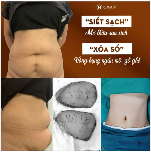 SẠCH MỠ, SIẾT EO SAU 1H VỚI TẠO HÌNH THÀNH BỤNG X-LINE – KIẾN TẠO VÒNG EO THON GỌN LÝ TƯỞNG