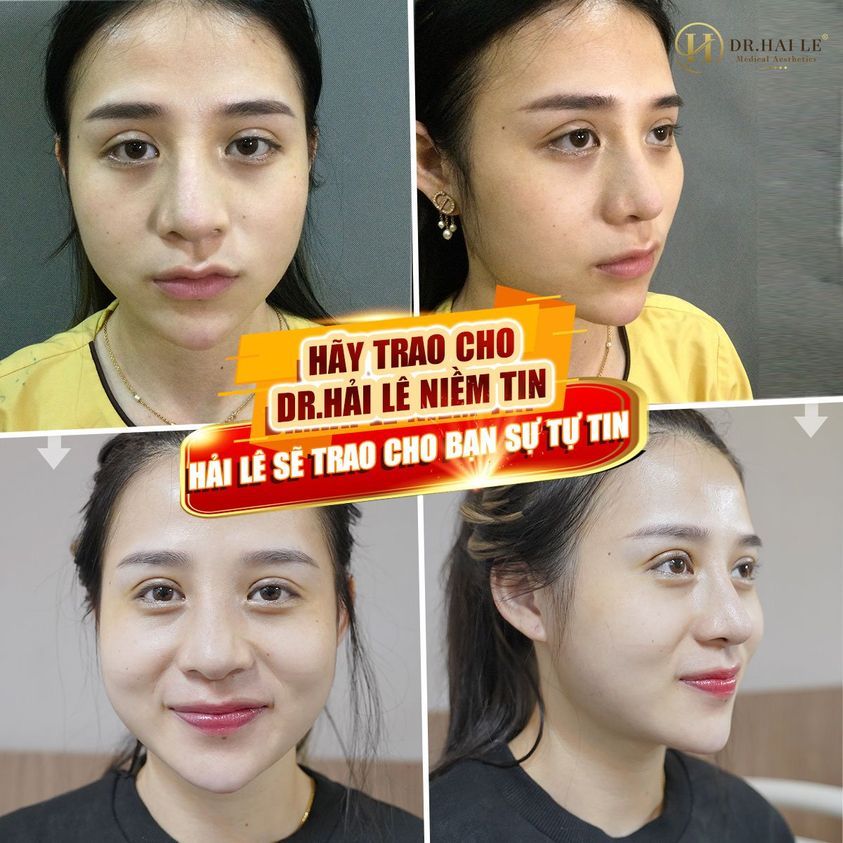 "Sau khi nhìn thấy kết quả sửa mí xong em ưng luôn​​​​​​​"