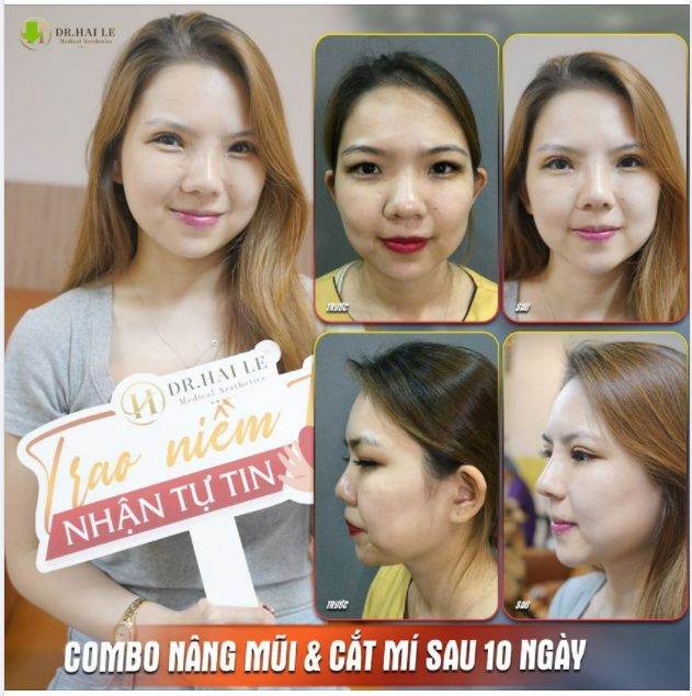 "Siêu phẩm" Cắt mí  Nâng mũi 10 ngày xuất sắc tại Dr.Hải Lê