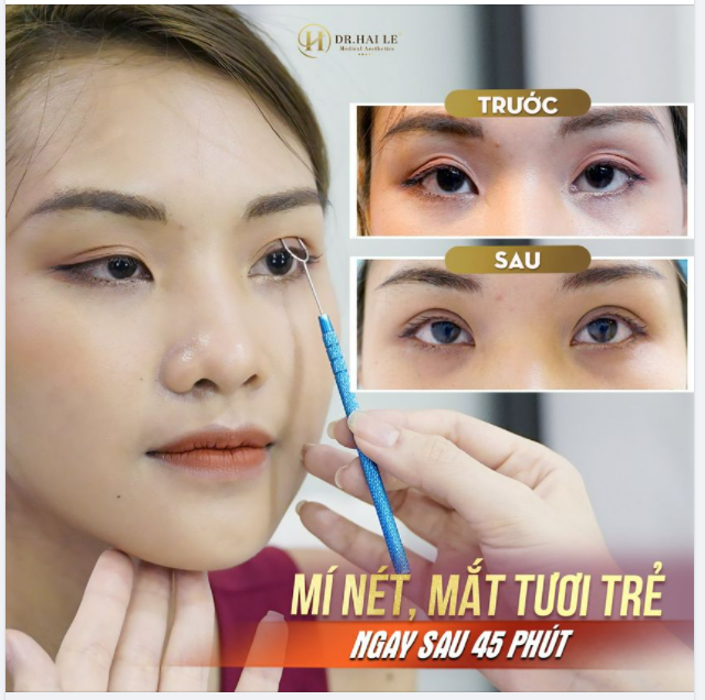 SIÊU PHẨM CẮT MÍ THẨM MỸ ĐẸP XUẤT SẮC ĐẾN CHỦ NHÂN CŨNG PHẢI GIẬT MÌNH