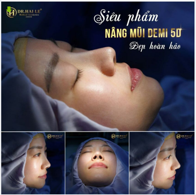 SỞ HỮU DÁNG MŨI CAO THANH TÚ cùng góc nghiêng hoàn hảo không còn là mơ ước với NÂNG MŨI DEMI 5D