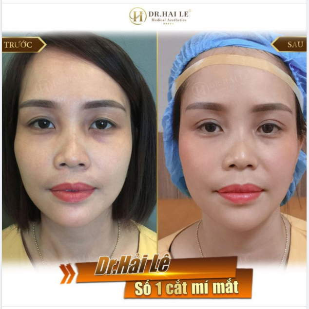 SỞ HỮU ĐÔI MẮT BIẾC XINH NHƯ NÀNG THƠ ...