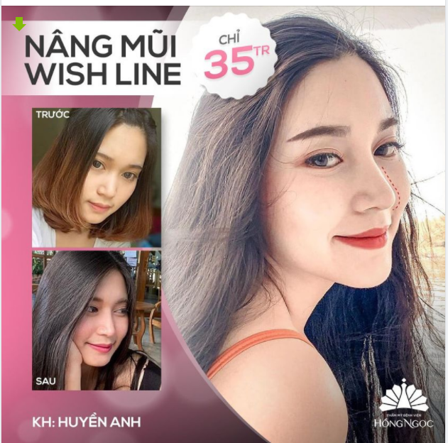 SỞ HỮU ''MŨI ĐẸP'' TỰA NÀNG THƠ - SANG MỌI GÓC NHÌN TIẾT KIỆM 25TR