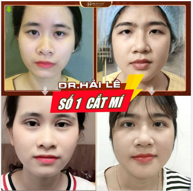 Sở hữu ngay MẮT TO TRÒN - NẾP MÍ ĐẸP TỰ NHIÊN với công nghệ cắt mí đỉnh cao tại Dr.Hải Lê.