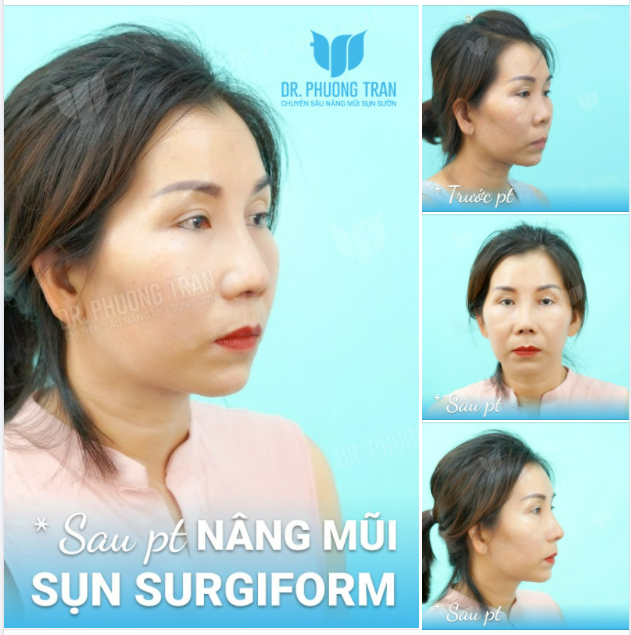 STRESS 1 NĂM VÌ CHIẾC MŨI NÂNG HẾCH VÀ CÁI KẾT