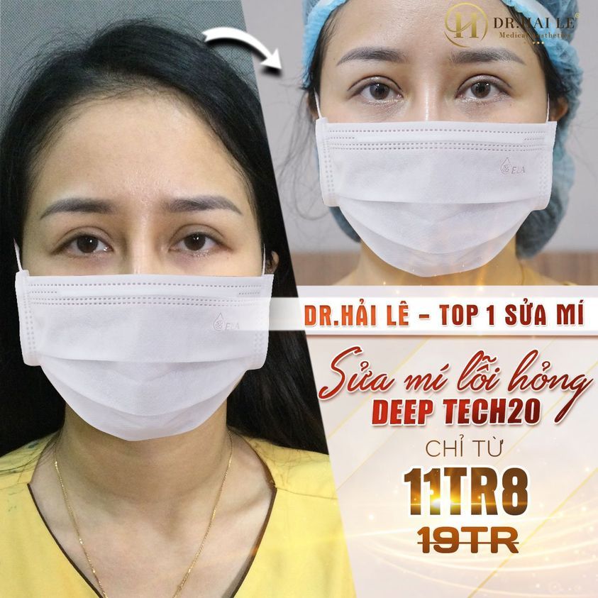 Sửa mí Deep Tech20 chỉ từ 11tr8 dành cho 5 KH/ngày đăng ký sớm nhất.