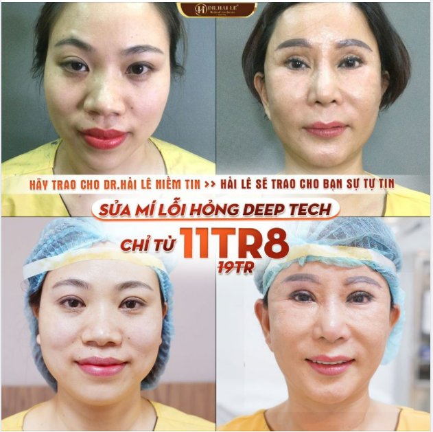 SỬA MÍ DEEP TECH20 - DR.HẢI LÊ CAM KẾT LUÔN LÀM KHÁCH HÀNG HÀI LÒNG.!!