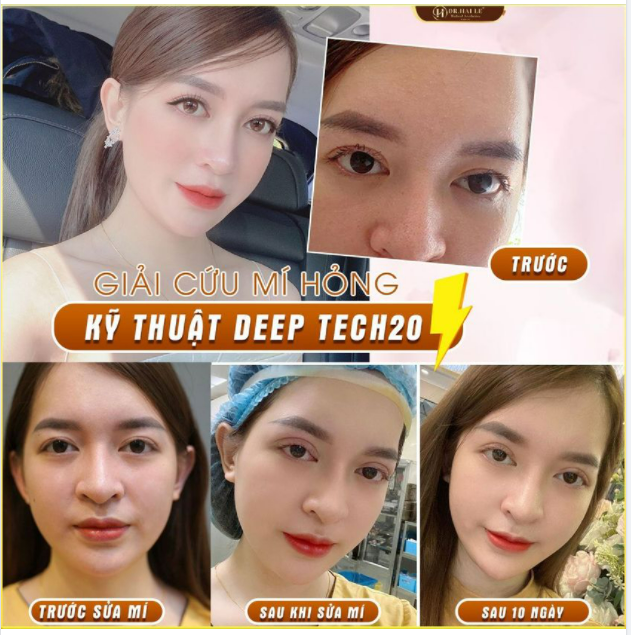 SỬA MÍ DEEP TECH20 - DR.HẢI LÊ SỐ 1 SỬA MÍ  DR.HẢI LÊ 12 NĂM- THÁNG SINH NHẬT - GIÁ PHÁ ĐẢO - QUÀ BẤT TẬN