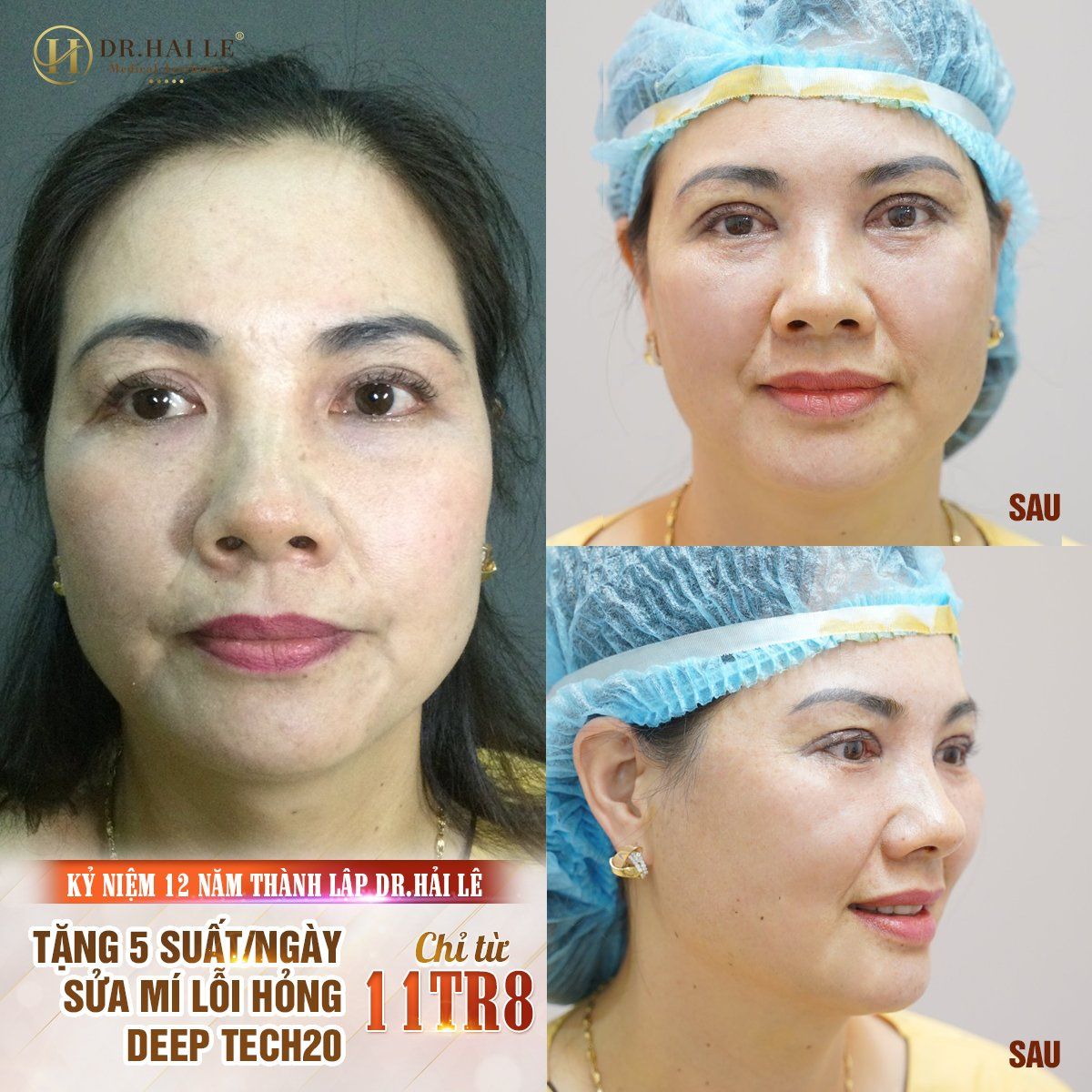 Sửa mí DEEP TECH20 với chi phí cực hời - Mừng kỷ niệm 12 năm thành lập Dr.Hải Lê.!