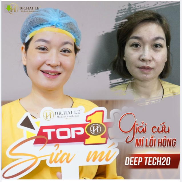 Sửa mí DEEP TECH20 với chi phí cực hời tại Dr.Hải Lê