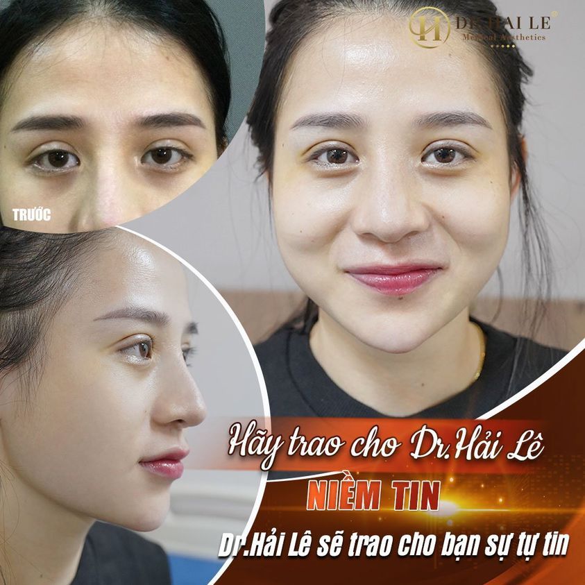 SỬA MÍ HỎNG: “GIẢI QUYẾT TÌNH TRẠNG MÍ QUÁ TO, ĐÍNH SÂU