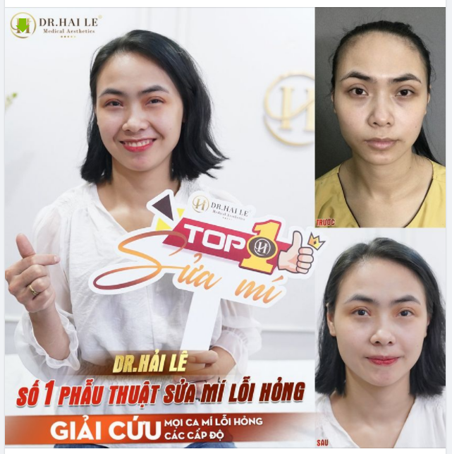 SỬA MÍ HỎNG: “GIẢI QUYẾT TÌNH TRẠNG MÍ QUÁ TO, ĐÍNH SÂU