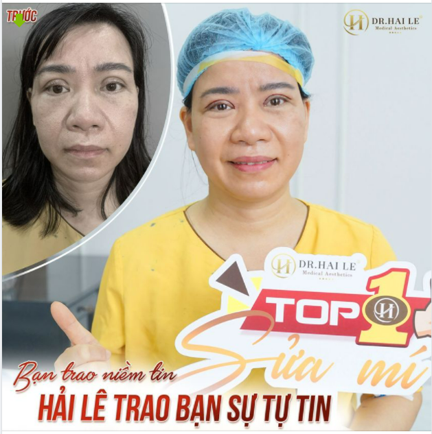 SỬA MÍ “XẤU, HỎNG” DEEP TECH - DR.HẢI LÊ LÀ ĐỊA CHỈ TOP 1