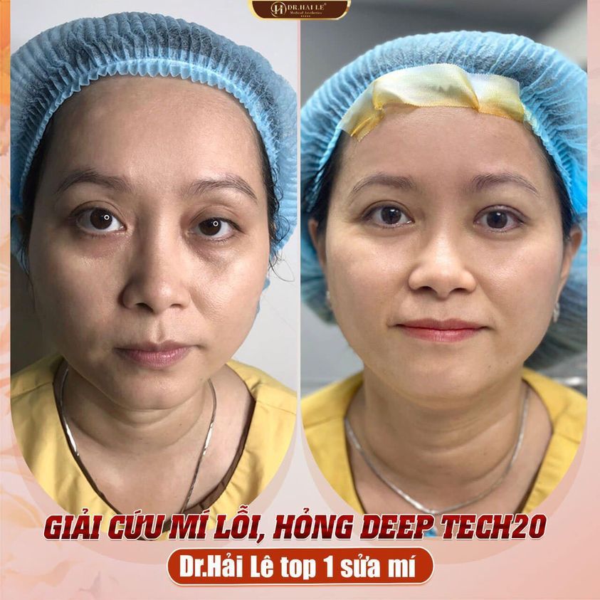 SỬA MÍ “XẤU, HỎNG” DEEP TECH20 - DR.HẢI LÊ TOP 1 SỬA MÍ