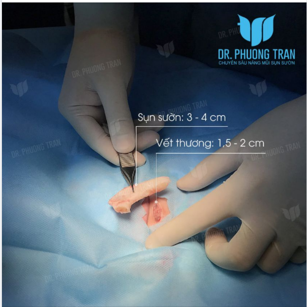 SỤN SƯỜN ĐƯỢC XEM LÀ CHẤT LIỆU TỐT NHẤT ĐỂ DỰNG TRỤ, TẠO HÌNH ĐẦU MŨI