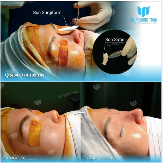 SỤN SƯỜN + SURGIFORM: BỘ ĐÔI HOÀN HẢO CHO CHIẾC MŨI ĐẸP TỰ NHIÊN - AN TOÀN - BỀN VỮNG