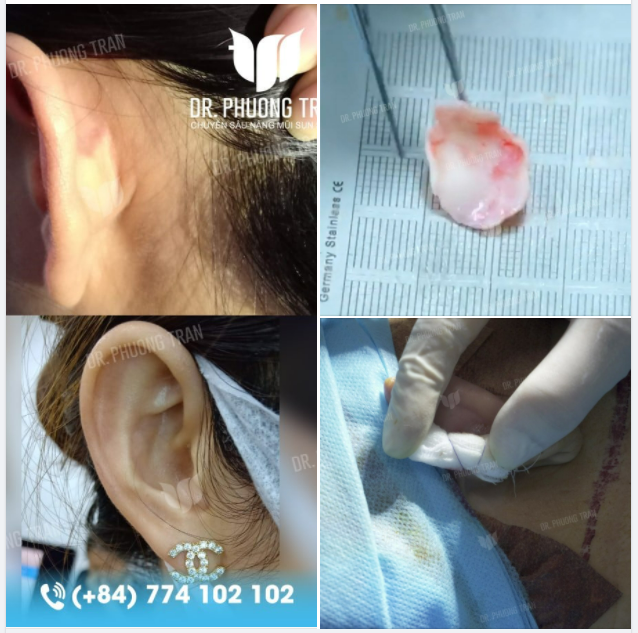 SỤN TAI ĐƯỢC DÙNG NHƯ THẾ NÀO TRONG PHẪU THUẬT NÂNG MŨI?