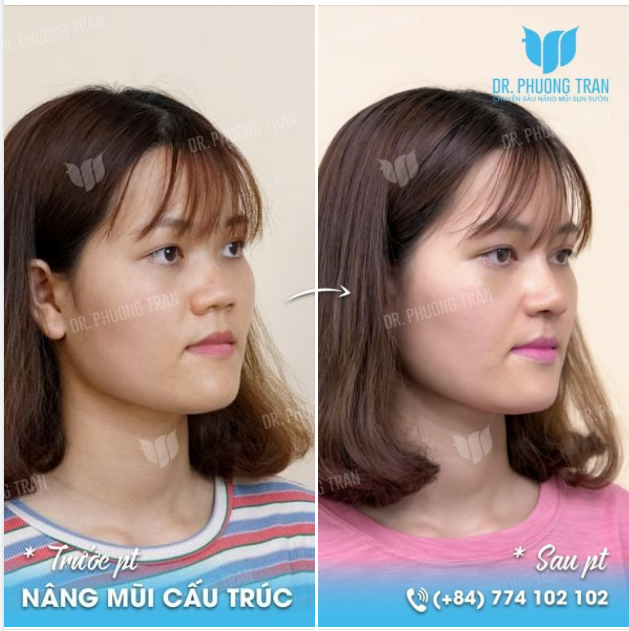 SỤN TỰ THÂN SẼ BỊ CO RÚT THEO THỜI GIAN?