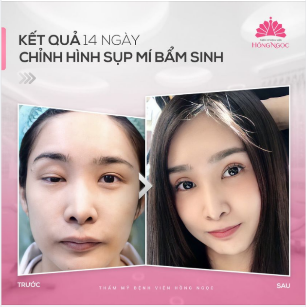 SỤP MÍ BẨM SINH CÓ KHẮC PHỤC ĐƯỢC KHÔNG