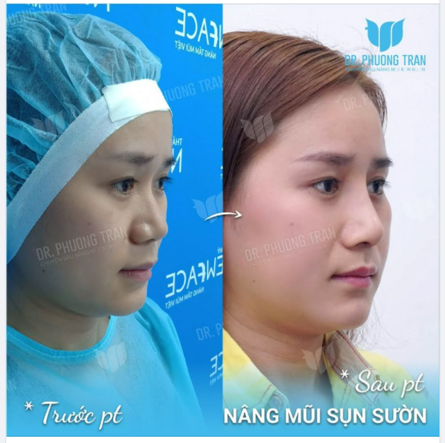 TẠI SAO BÁC SĨ LUÔN ƯU TIÊN NÂNG MŨI BẰNG SỤN SƯỜN?