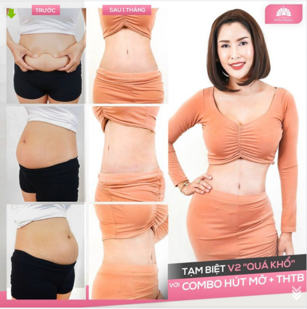 TẠM BIỆT VÒNG 2 ''QUÁ KHỔ'' VỚI COMBO HÚT MỠ + TẠO HÌNH THÀNH BỤNG