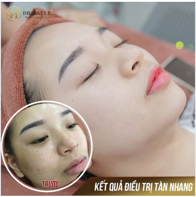Tàn nhang, kẻ thù của làn da. CHUYỆN NHỎ!