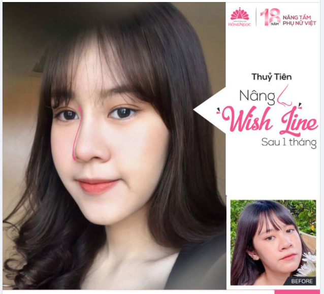 TĂNG THẦN THÁI - TRÚT TỰ TI SAU 1 THÁNG NÂNG MŨI WISH LINE