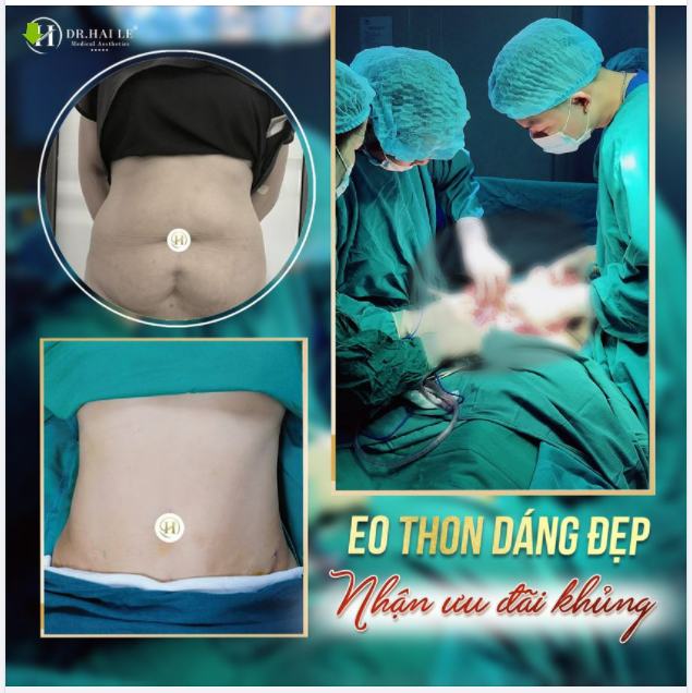 TẠO HÌNH THÀNH BỤNG X-LINE – KIẾN TẠO VÒNG EO THON GỌN LÝ TƯỞNG